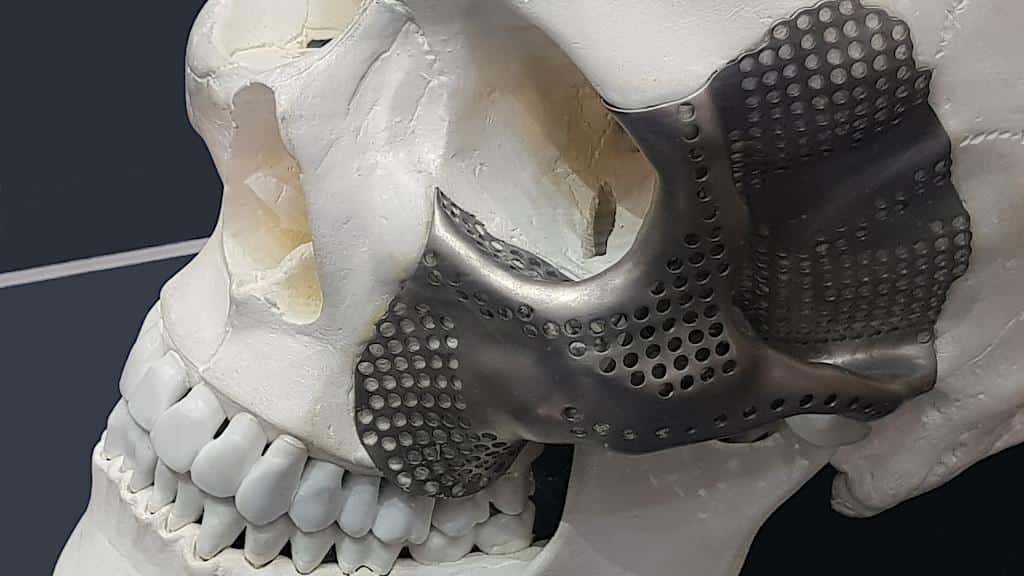 3D Printing in Medicine Scull with Implant howto3Dprint.net Discover The World of 3D Print